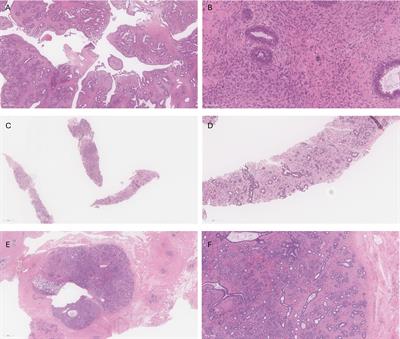 Case report: Possible role of low-dose PEM for avoiding unneeded procedures associated with false-positive or equivocal breast MRI results